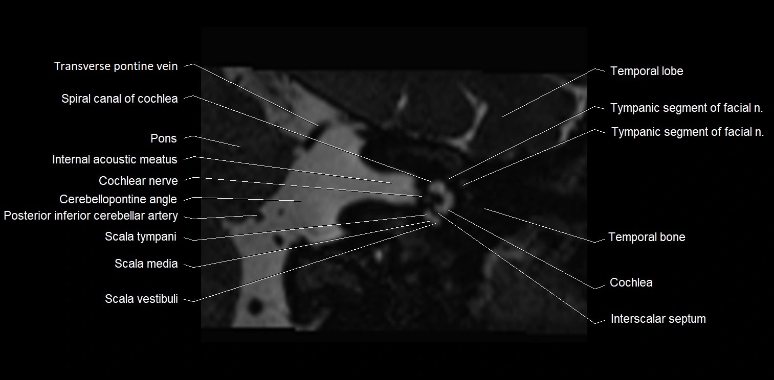 MRI Internal auditory meatus (IAM) coronal cross sectional labelled anatomy image 7.webp